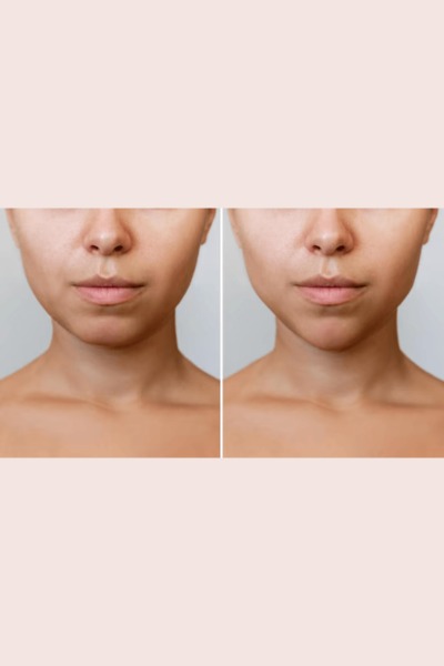 Dermal Fillers
