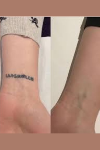 Tattoo Removal Treatment