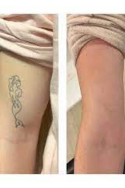 Tattoo Removal Treatment