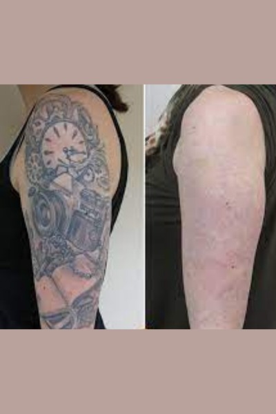 Tattoo Removal Treatment