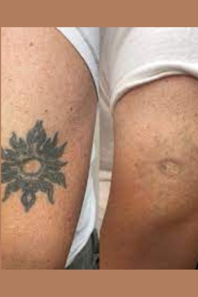 Tattoo Removal Treatment