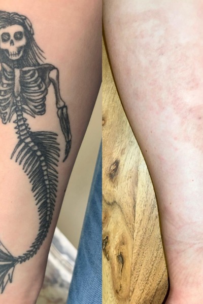 Tattoo Removal Treatment