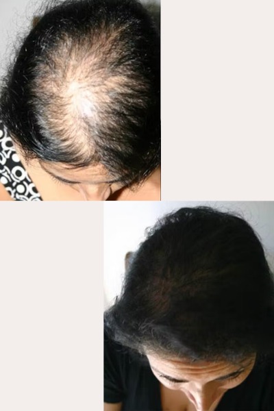 Laser Hair Stimulation