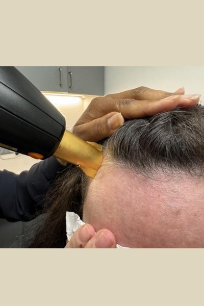Laser Hair Stimulation
