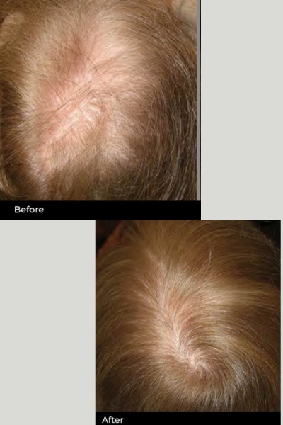 Laser Hair Stimulation