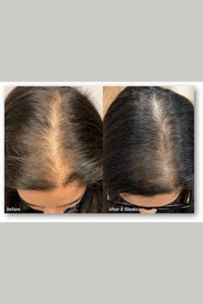Hair Grow Theropy