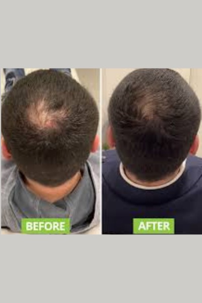 Hair Grow Theropy