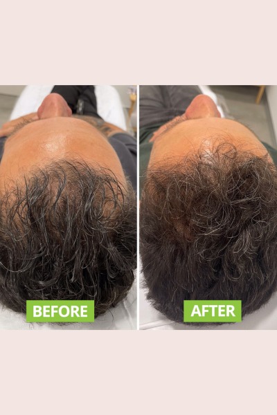 Hair Grow Theropy
