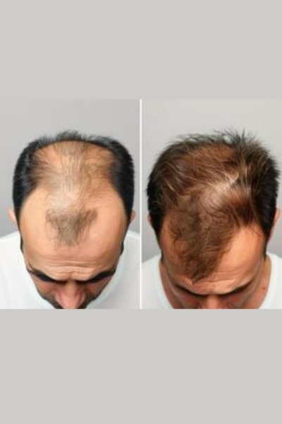 Hair Grow Therapy