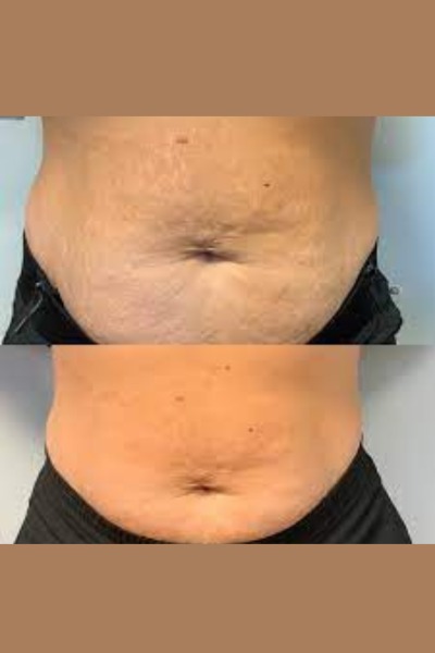Strech Mark Treatment