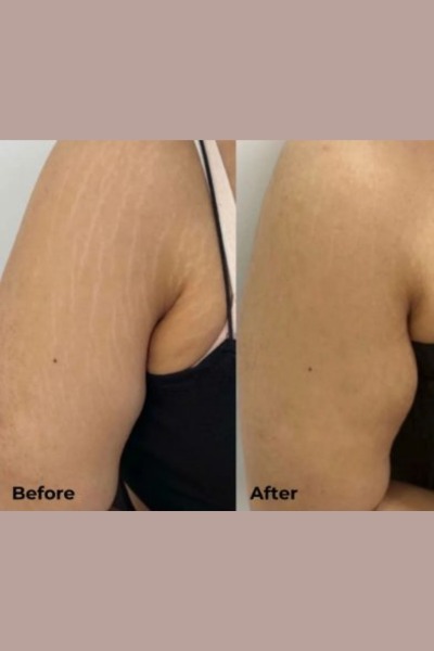 Strech Mark removal treatment