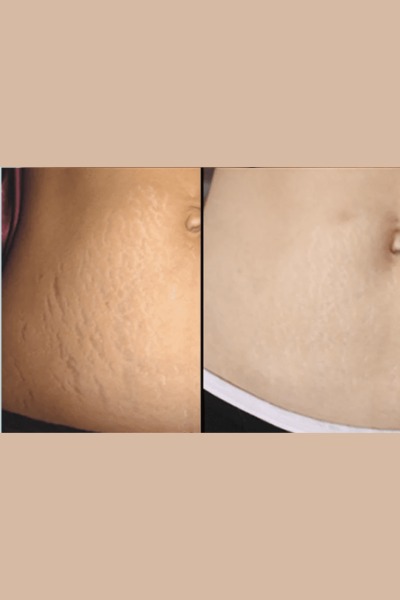 Strectch Marks Treatment