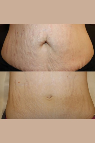 Strech Marks Treatment