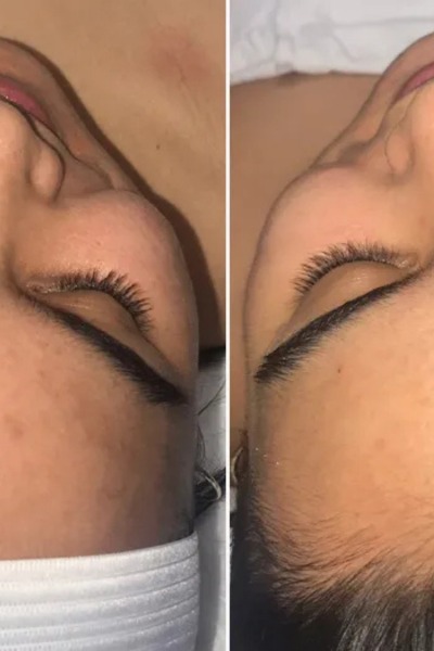 Medicated Facial Treatment