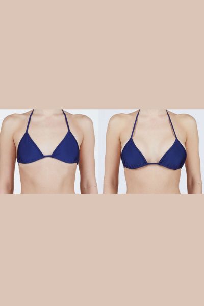 Breast Lift Treatment