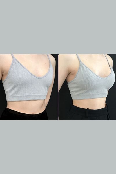 Breast Lift Treatment