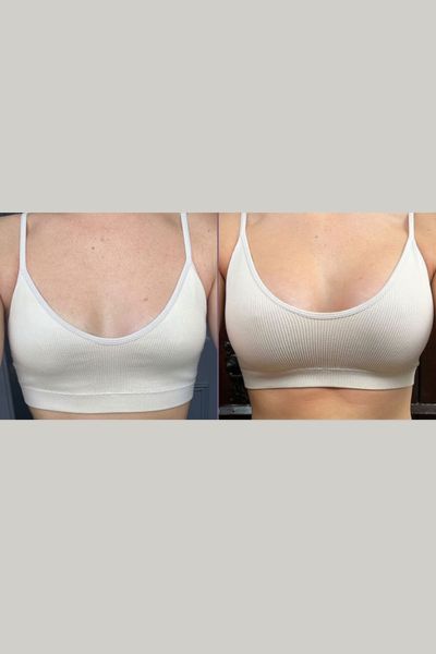 Breast Lift Treatment