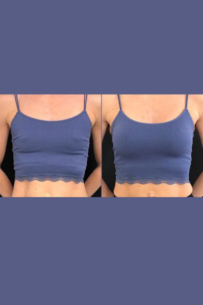 Breast Lift Treatment
