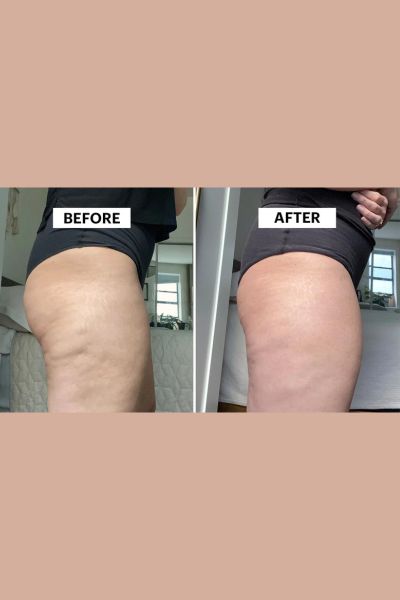 Cellulite Reduction Treatment
