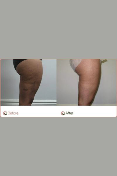 Cellulite Reduction Treatment