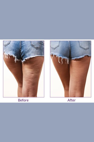 Cellulite Reduction Treatment