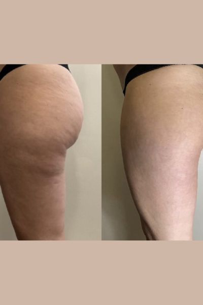 Cellulite Reduction Treatment