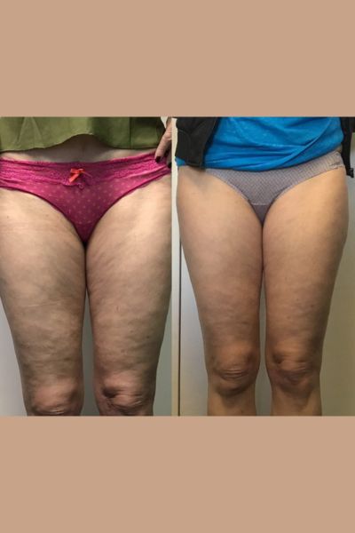 Cellulite Reduction Treatment