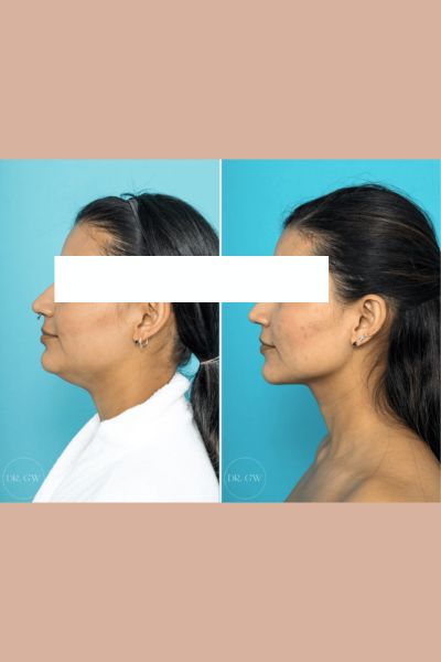 Double Chin Reduction Treatment