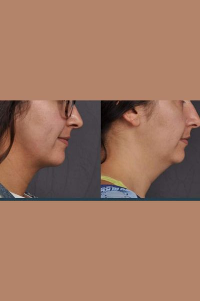 Double Chin Reduction Treatment