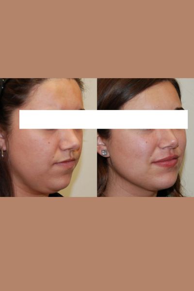 Double Chin Reduction Treatment
