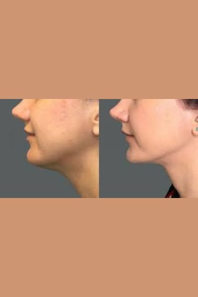 Double Chin Reduction Treatment
