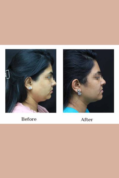 Double Chin Reduction Treatment