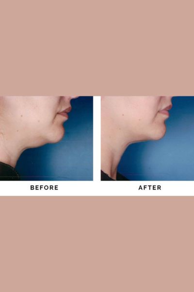 Double Chin Reduction Treatment