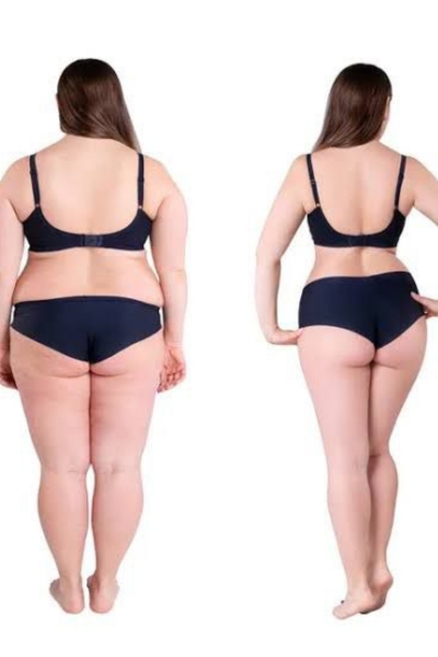 Hip Thigh Reduction Treatment