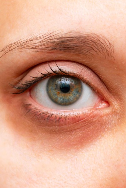 Under Eye Dark Circle