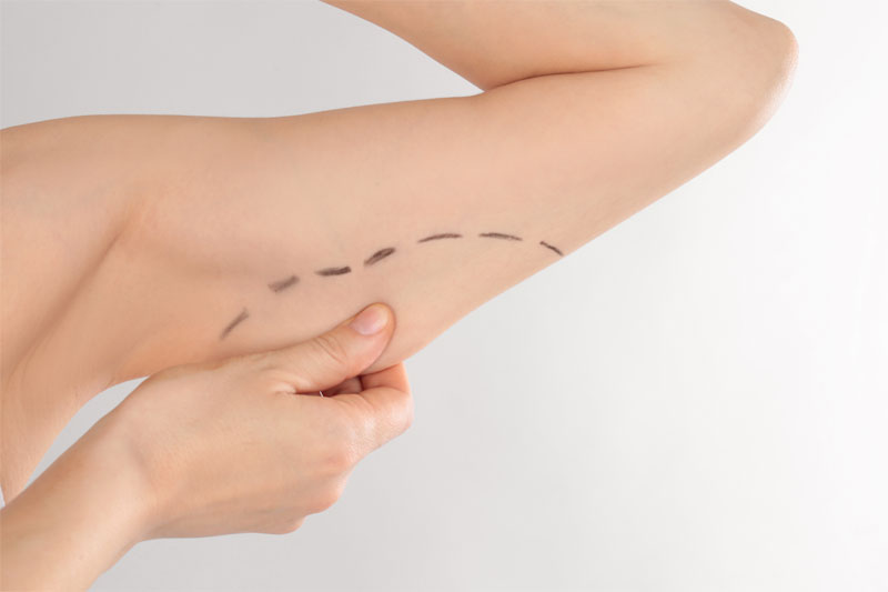 Arm Contouring