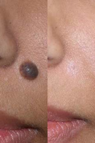 Mole Removal