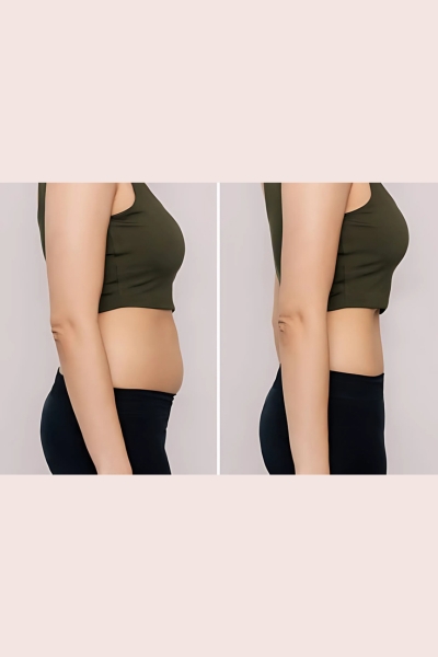 Non Surgical Inch Loss Treatment