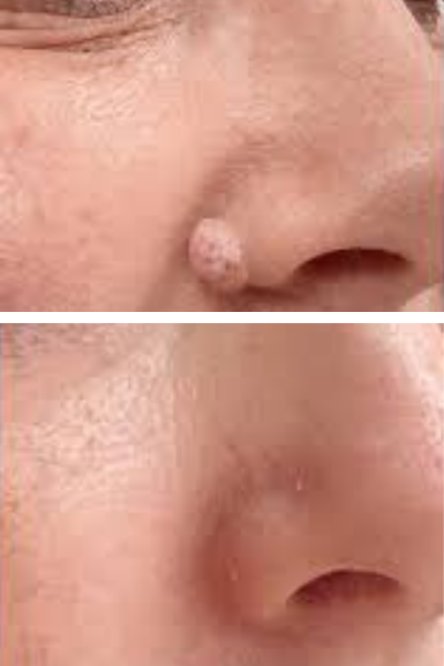 Mole Removal