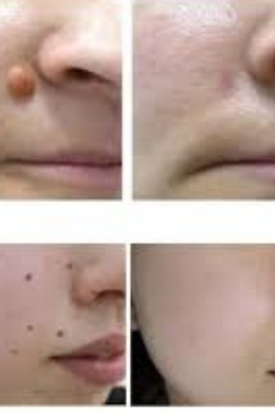 Mole Removal