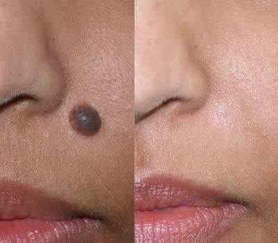 Mole Removal