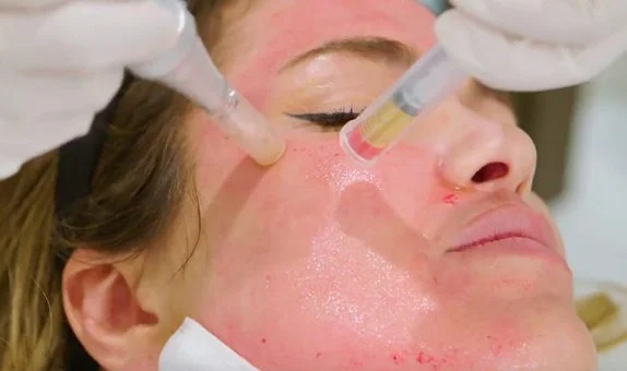 Celebrity Vampire Facial