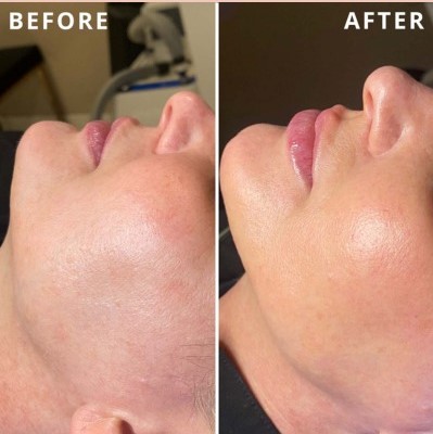 Hydrafacial Price in Pune
