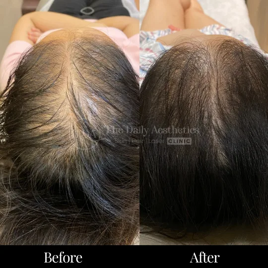 PRP Hair Treatment Before After 1