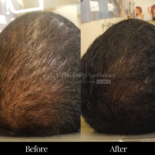 PRP Hair Treatment Before After 2