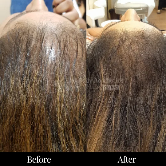 PRP Hair Treatment Before After 3