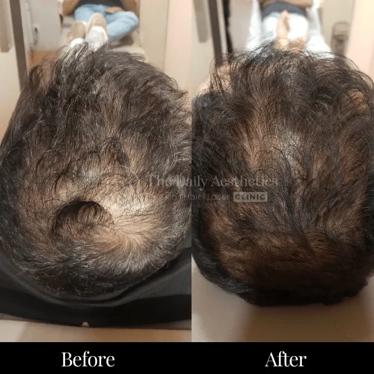 PRP Hair Treatment Before After 5