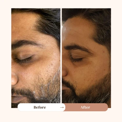 laser hair reduction - TDA