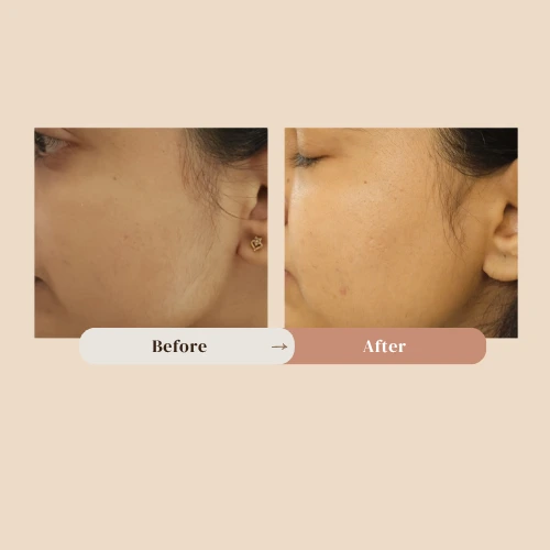 laser hair reduction results