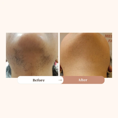 laser hair removal - TDA